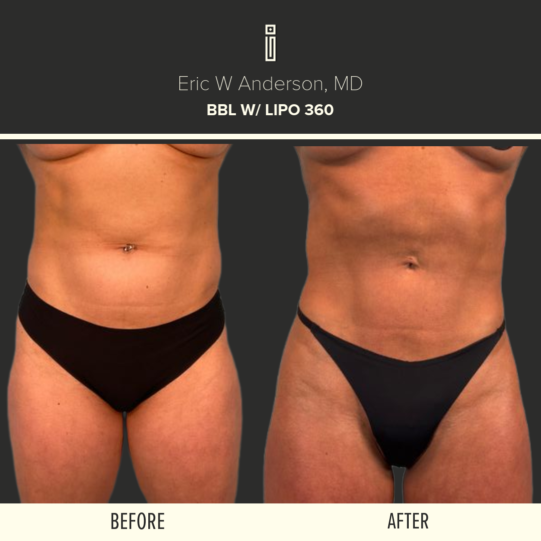 LIPOSUCTION