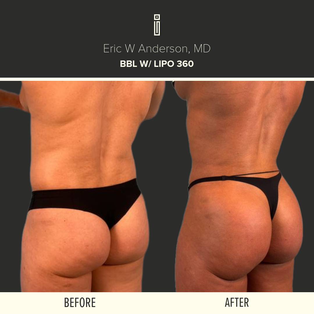 LIPOSUCTION