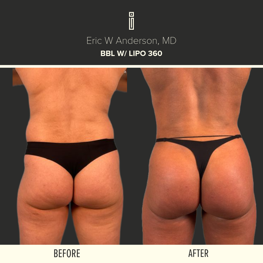 LIPOSUCTION