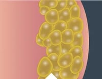 Fat_Cells_Closeup_4_Desktop_259x200-1 Fat_Cells_Closeup_4_Desktop_259x200-1