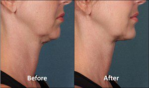 Kybella_Kythera2