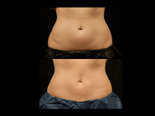 coolsculpting