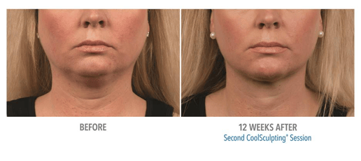 coolsculpting