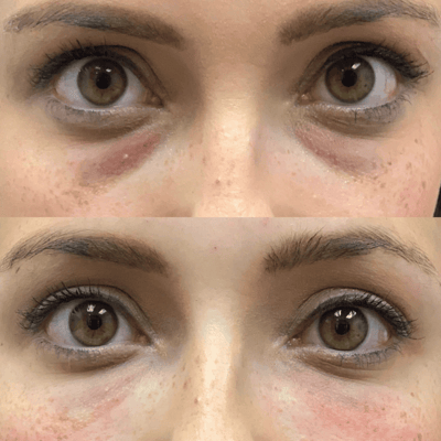 Prp Undereye treatment Prp Undereye treatment