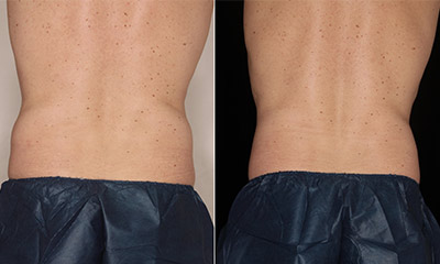 coolsculpting fat reduction and body contouring at Cosmedica, Victoria, BC
