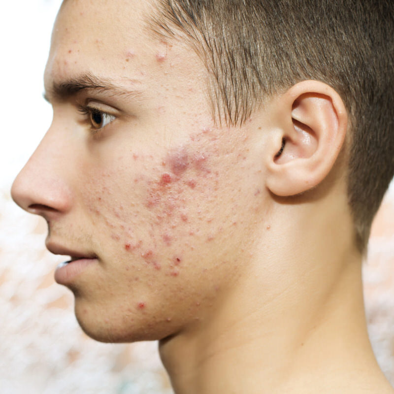 Acne Awareness Week: Emotional impact of acne on teens underestimated