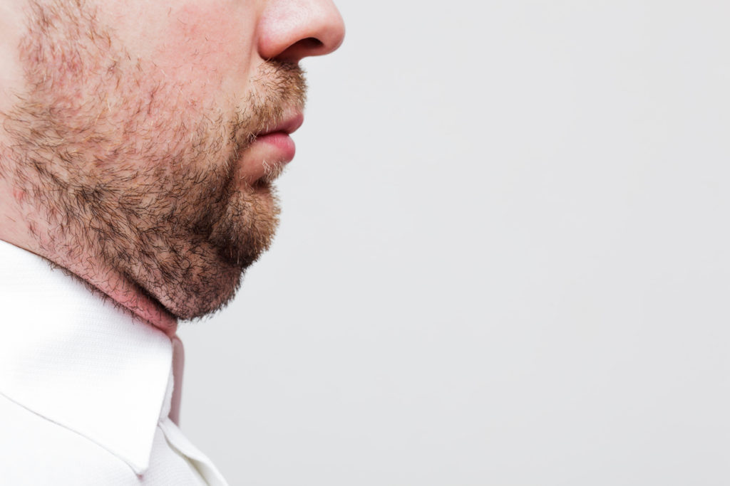 Submental Fullness with Dr. Anthony Rossi