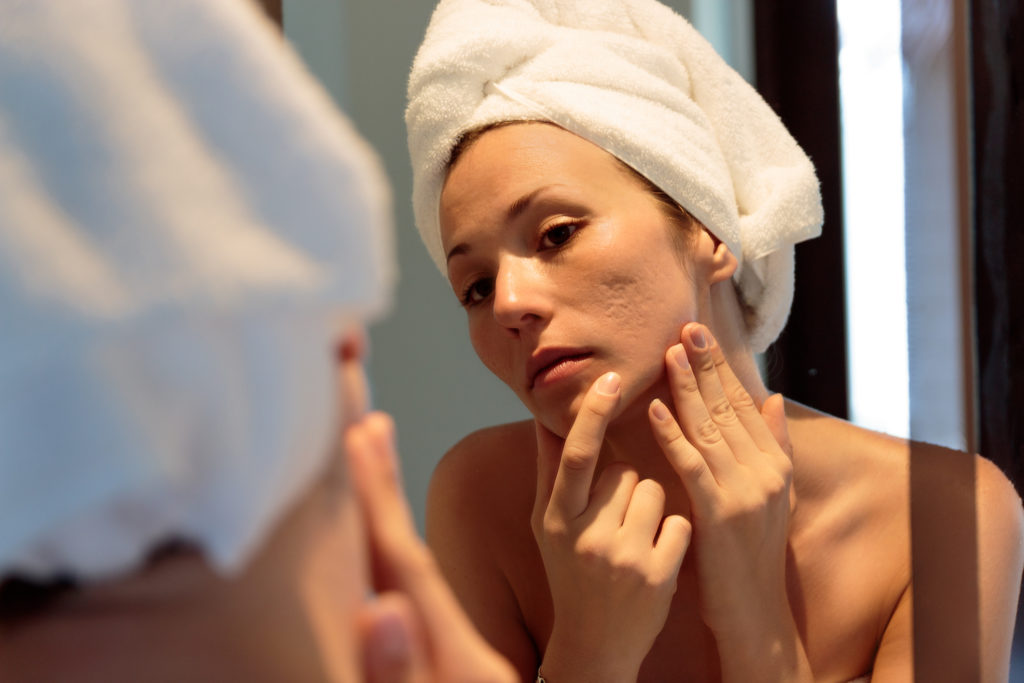 Filler for Acne Scars