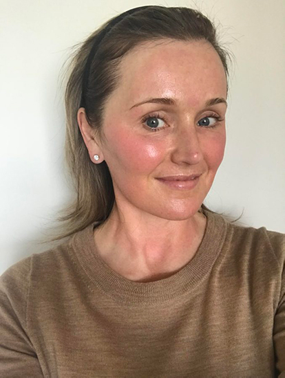Immediate-post-Microneedling