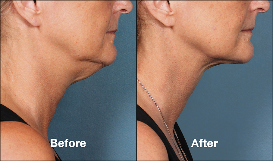 The Double Chin’s Days are Numbered – Two new treatments available!
