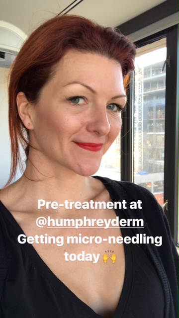 Pre-treatment