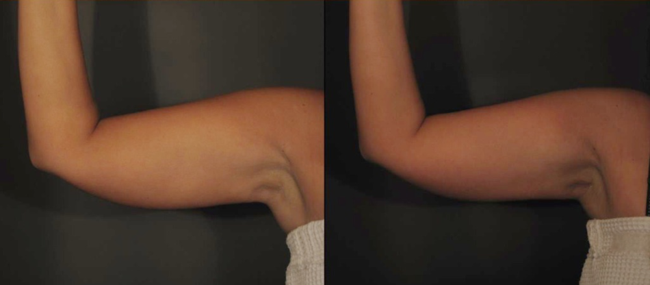 muscle