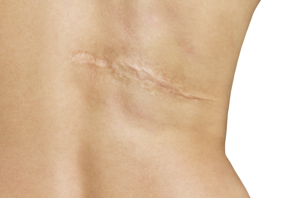 aspireMD - SCAR MINIMIZING RESURFACING LASER